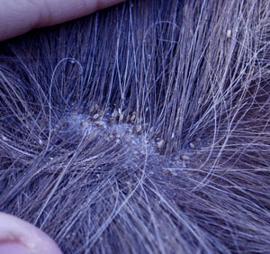 Яйца (гниды) отложенные у основания волоса